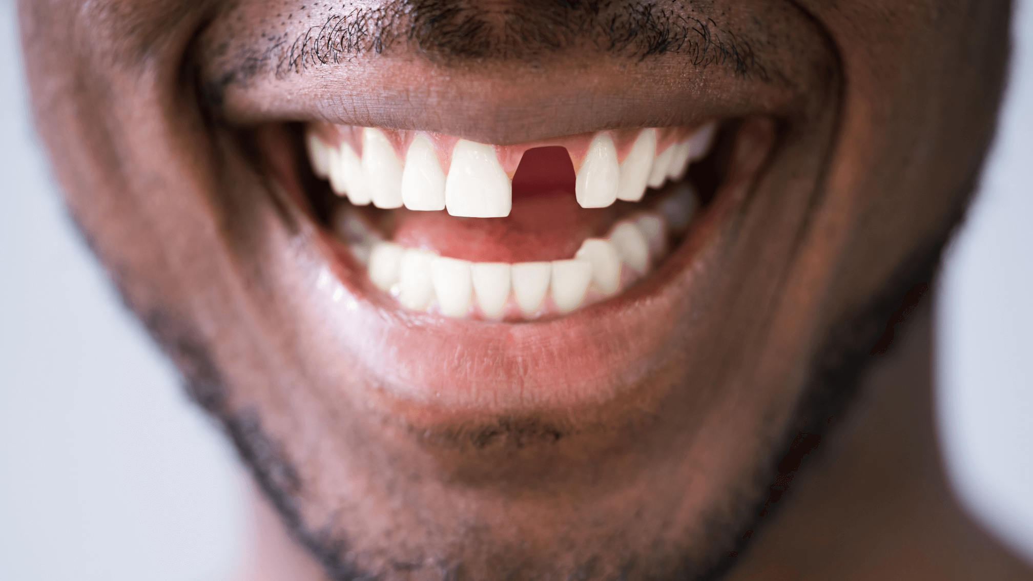 Missing tooth clause
